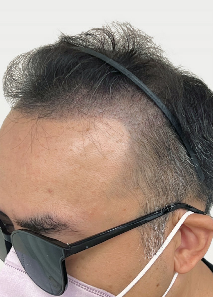 紋髪濃密案例_1