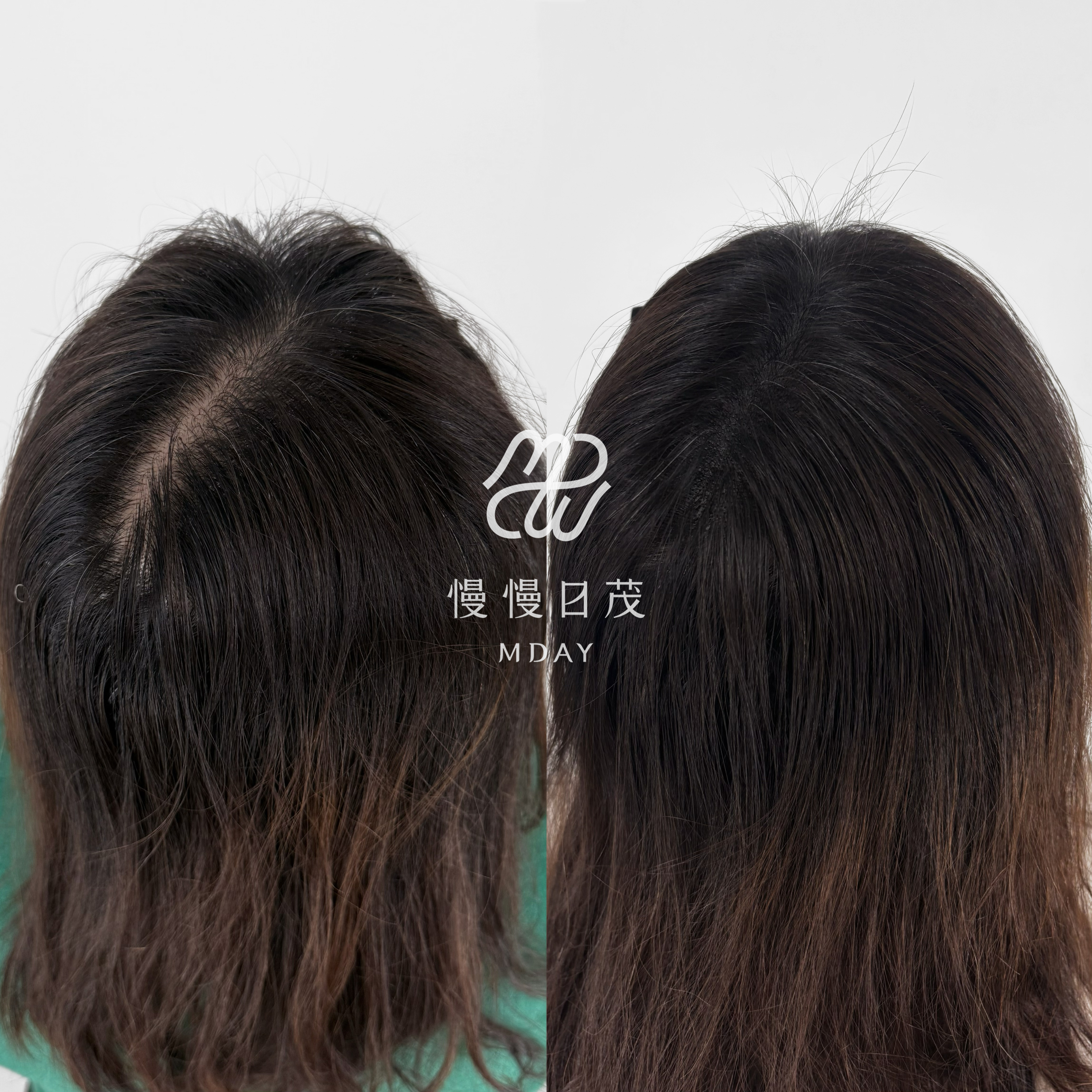 女性後腦勺填補