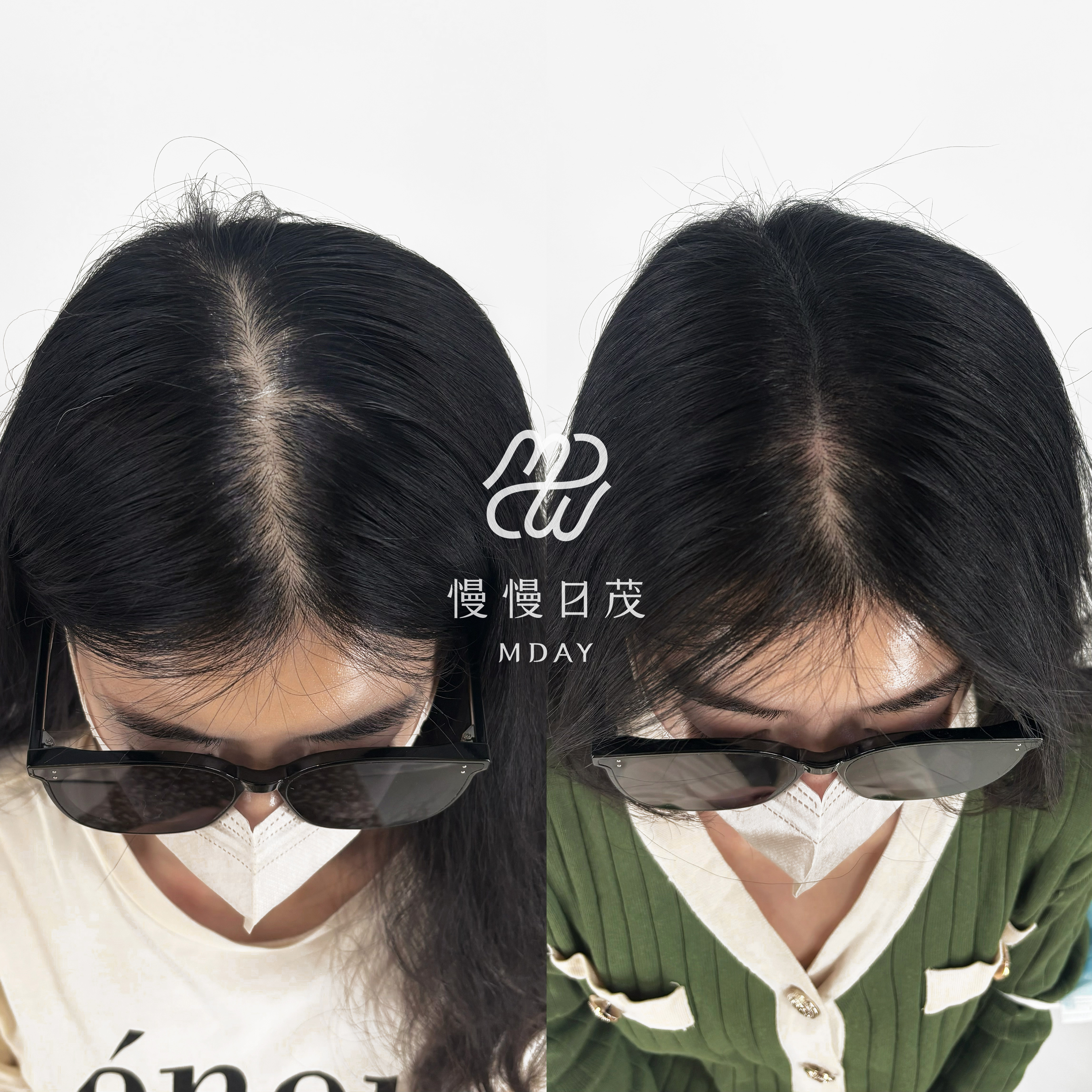 女性後腦勺填補