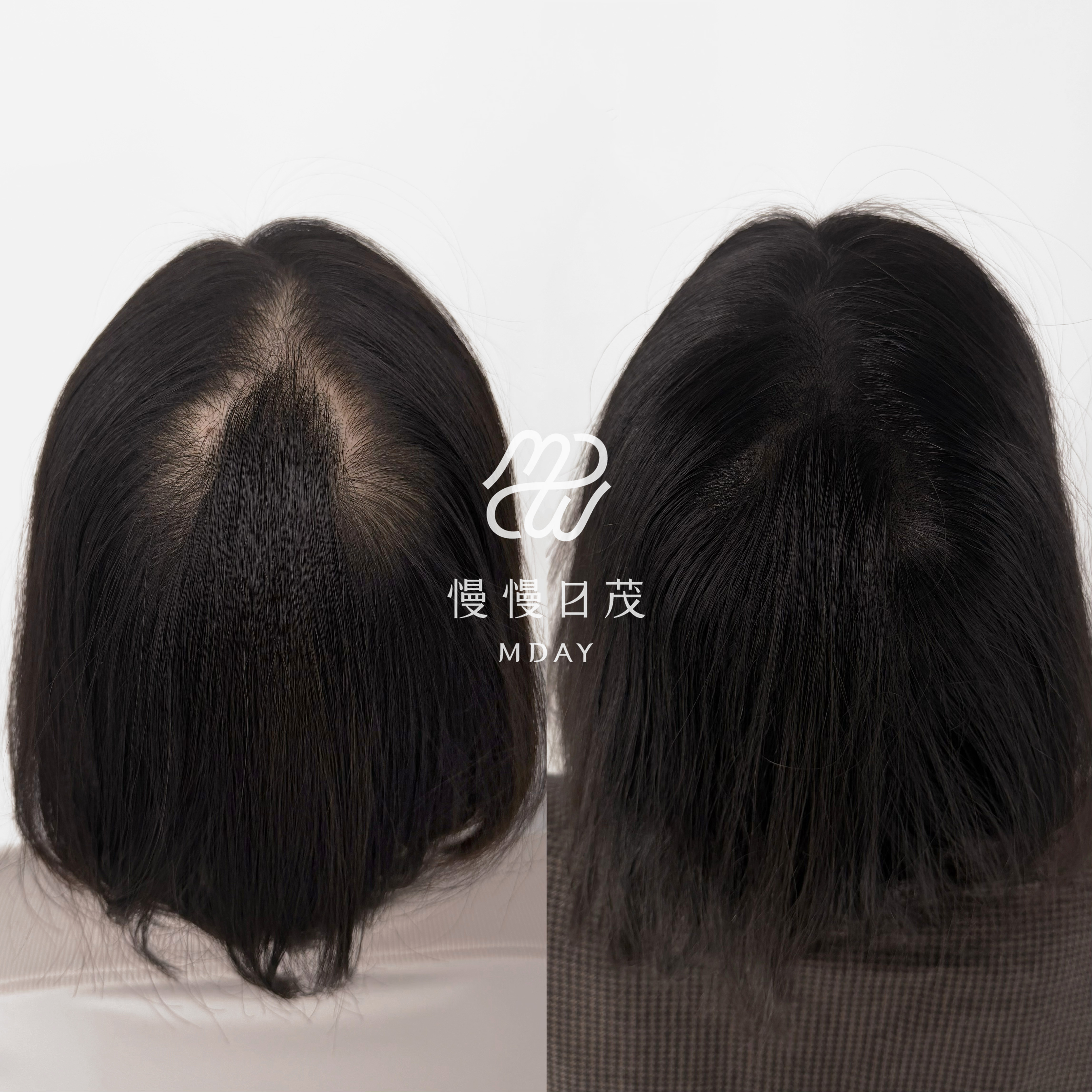 女性後腦勺填補