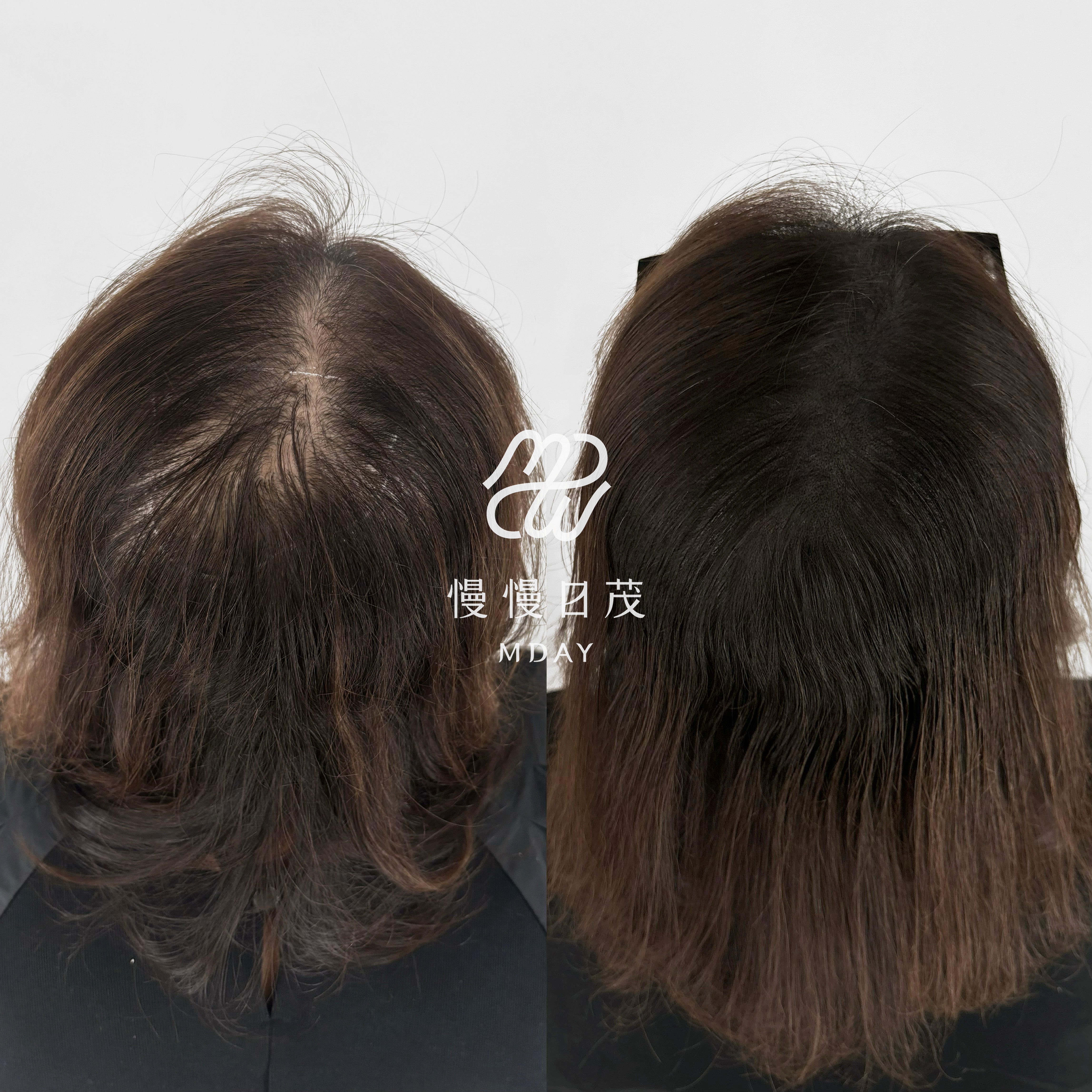 女性後腦勺填補