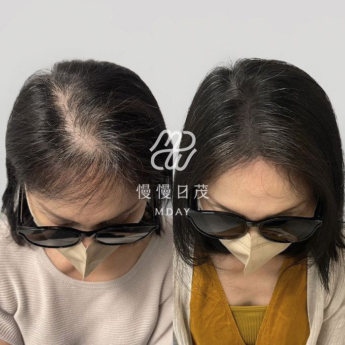 女性頭頂填補