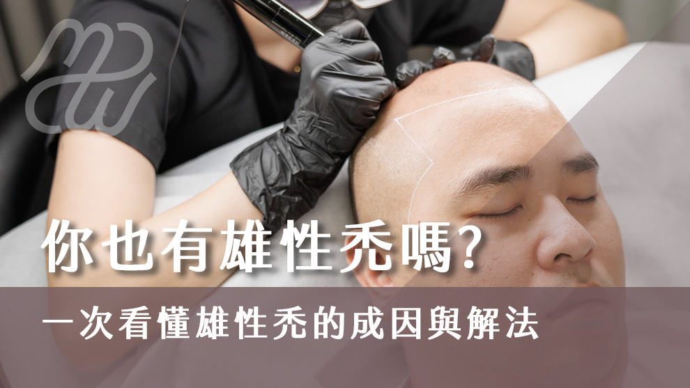 你也有雄性禿嗎？一次看懂雄性禿的成因與解決方法