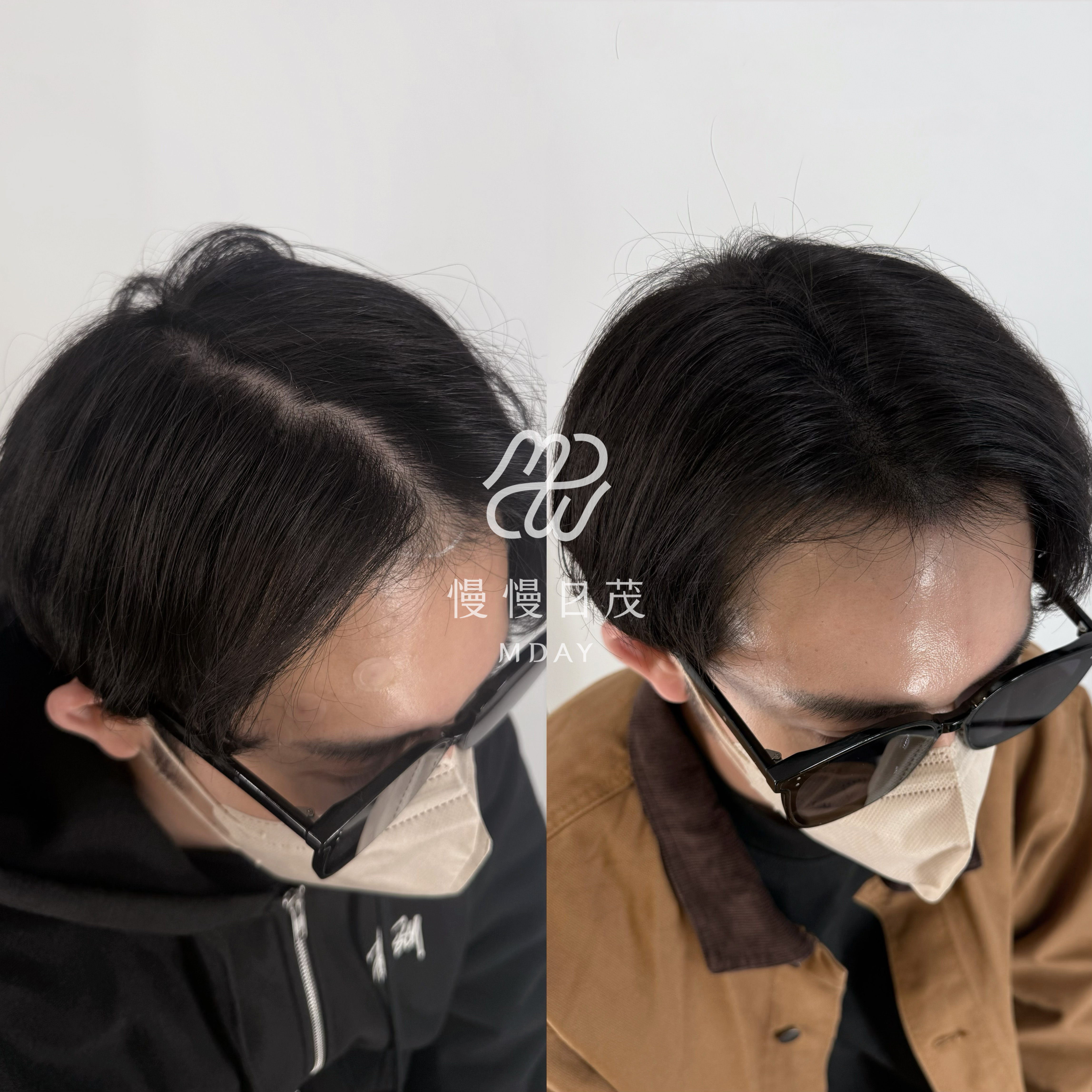 男性分線填補