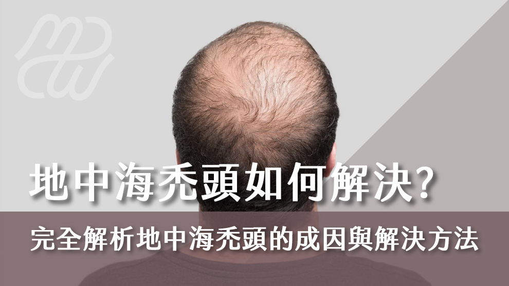 地中海禿頭如何解決？完全解析地中海禿頭的成因與解決方法