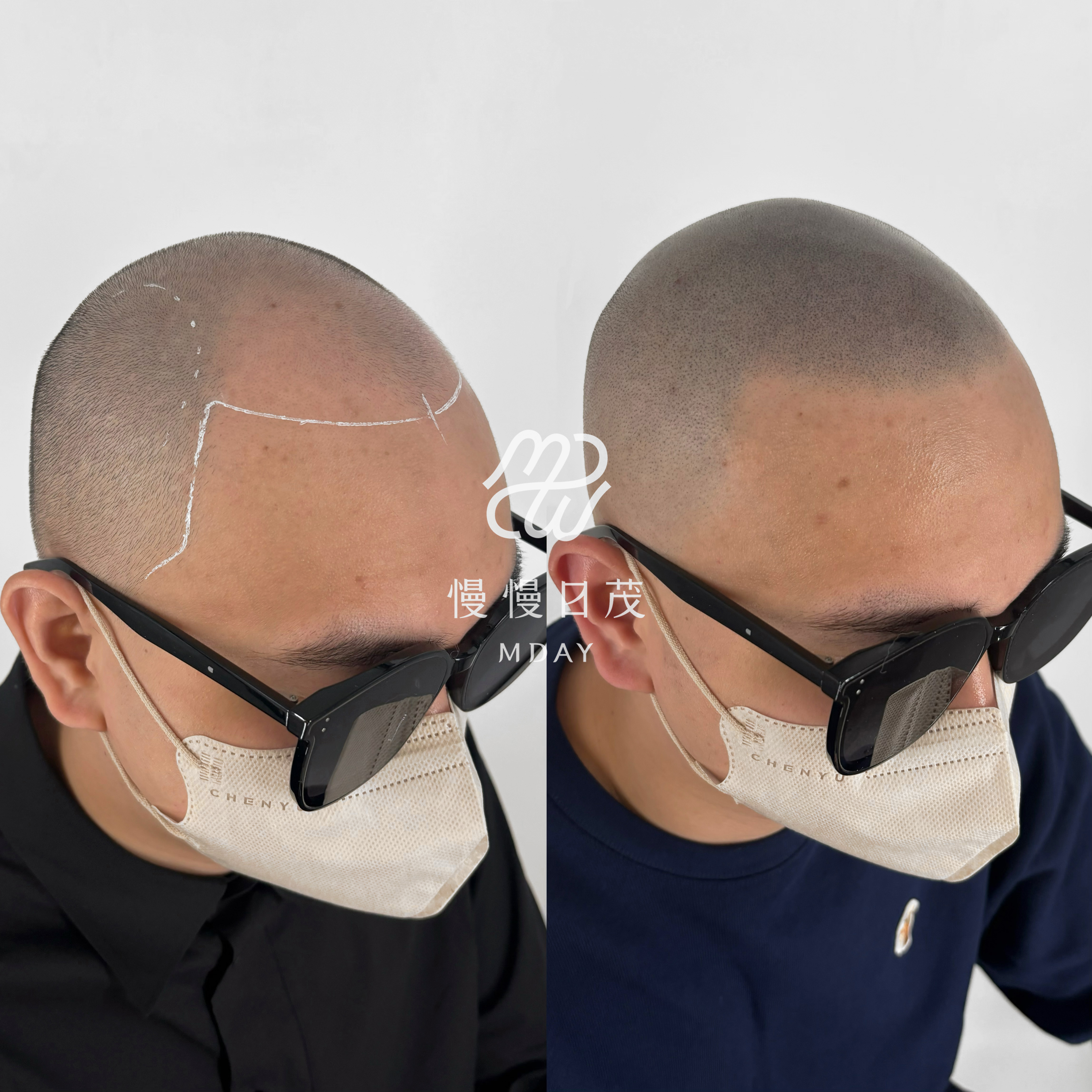 光頭髮際線重建