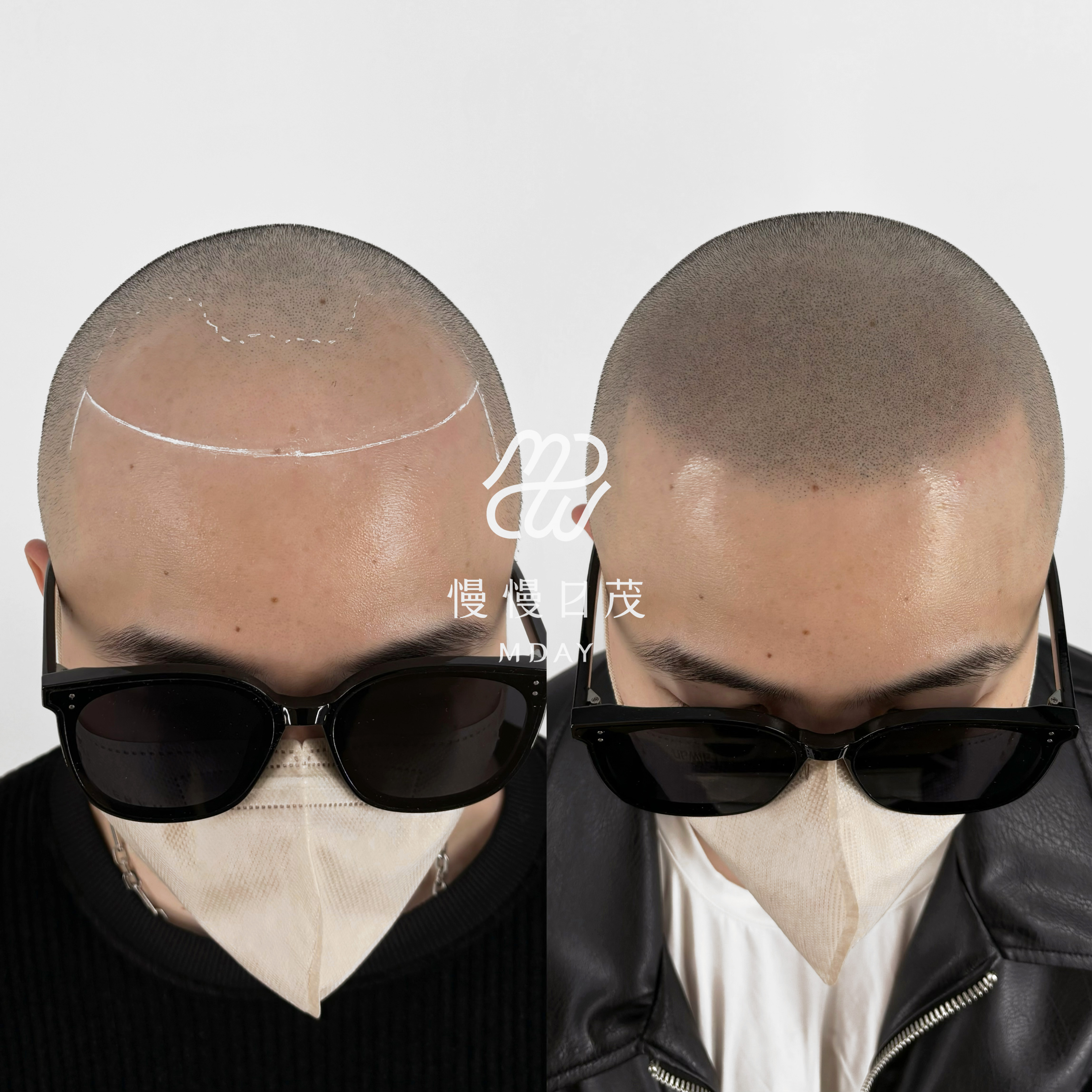 光頭髮際線重建