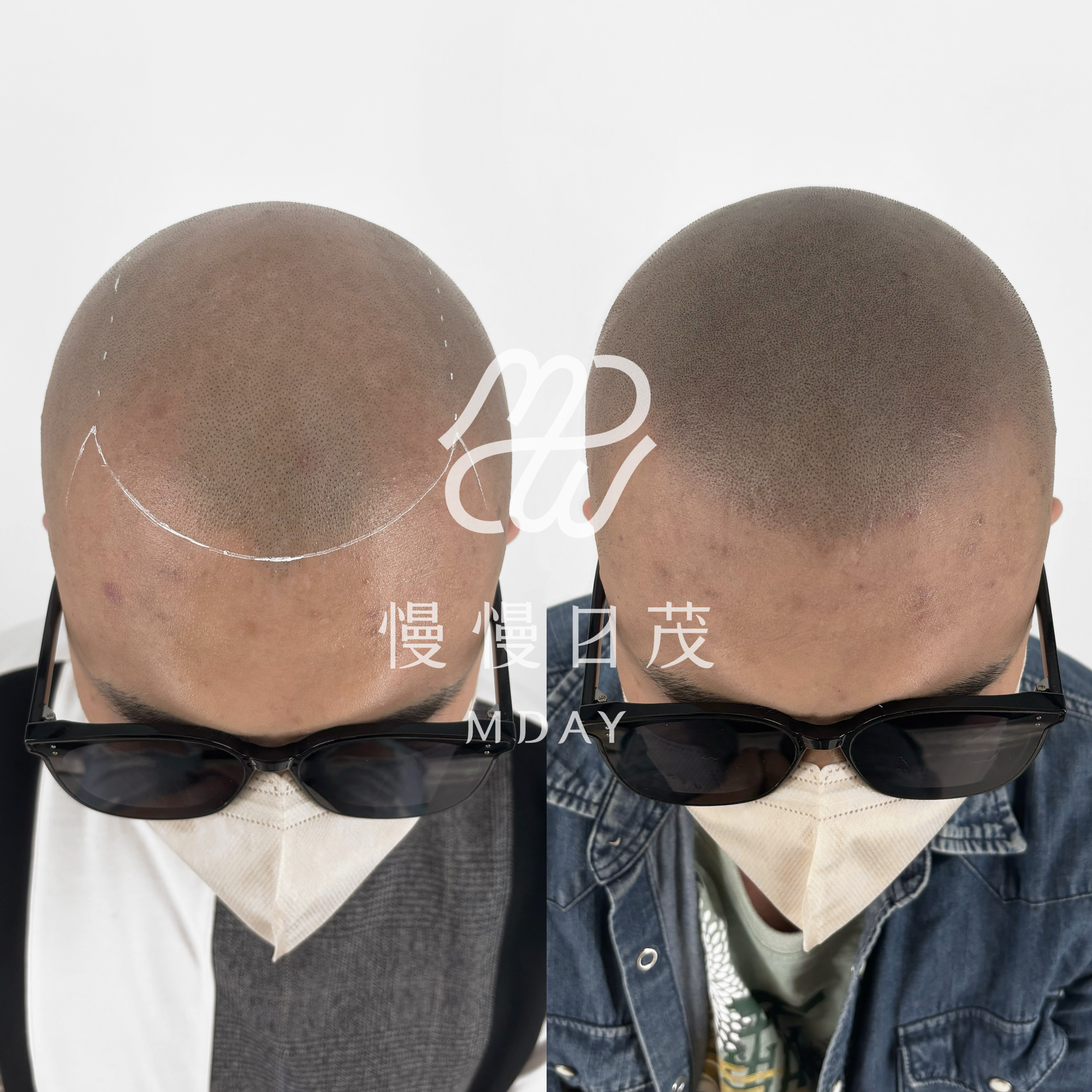 光頭髮際線重建