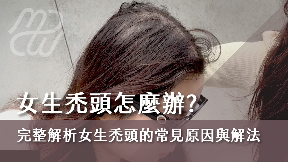 女生禿頭怎麼辦？完整解析女生禿頭的常見原因與解決方法