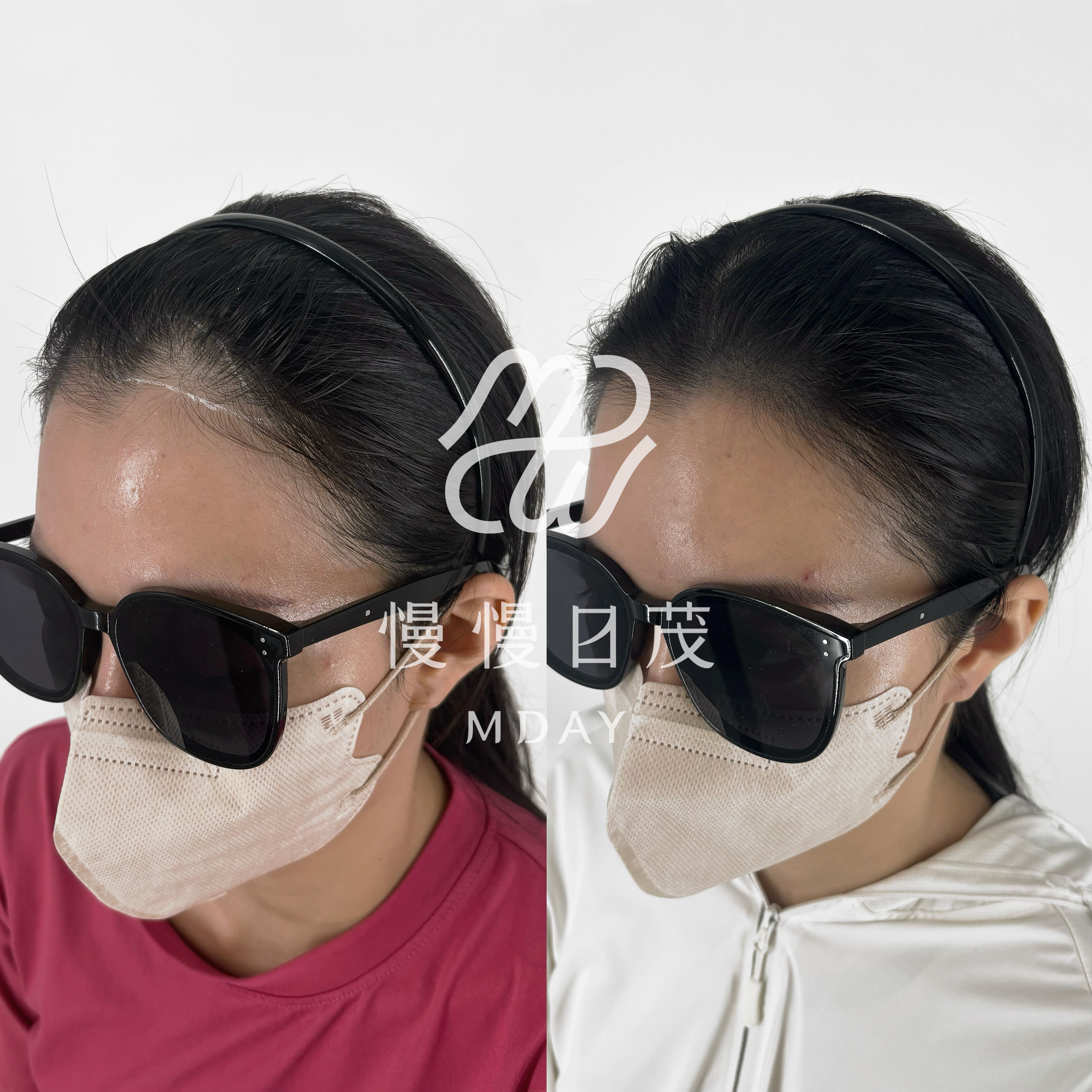 女性髮際線填補