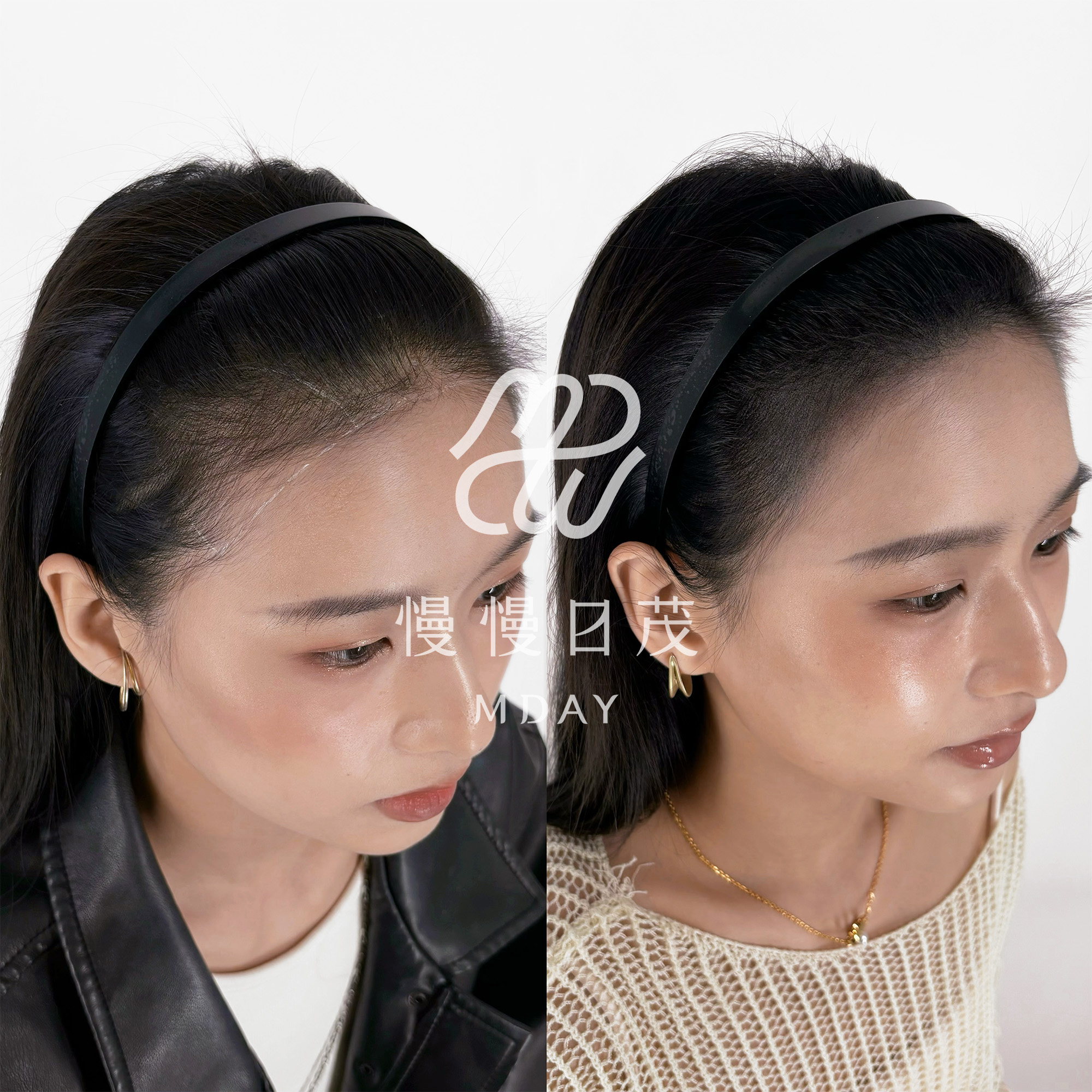 女性髮際線填補