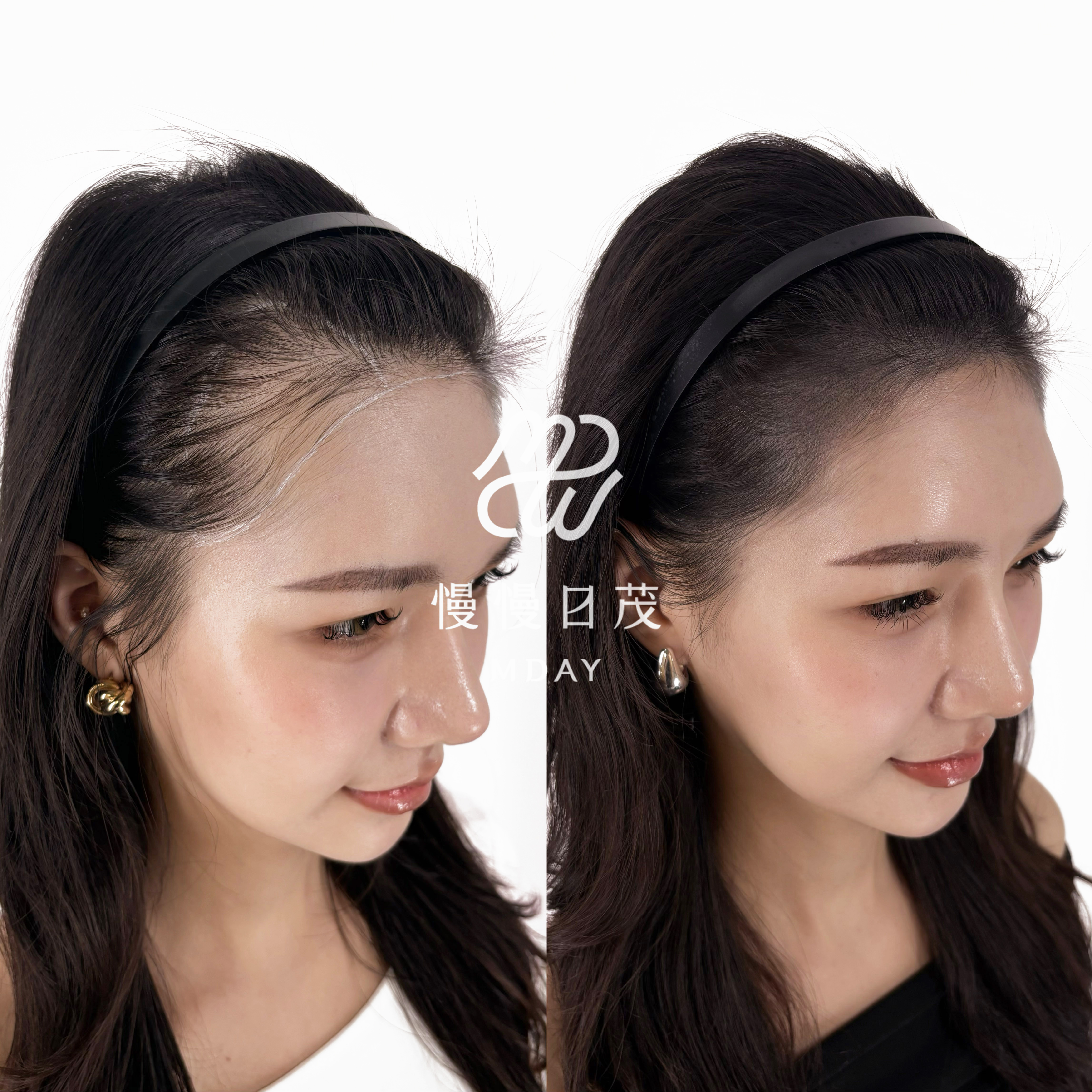 女性髮際線填補