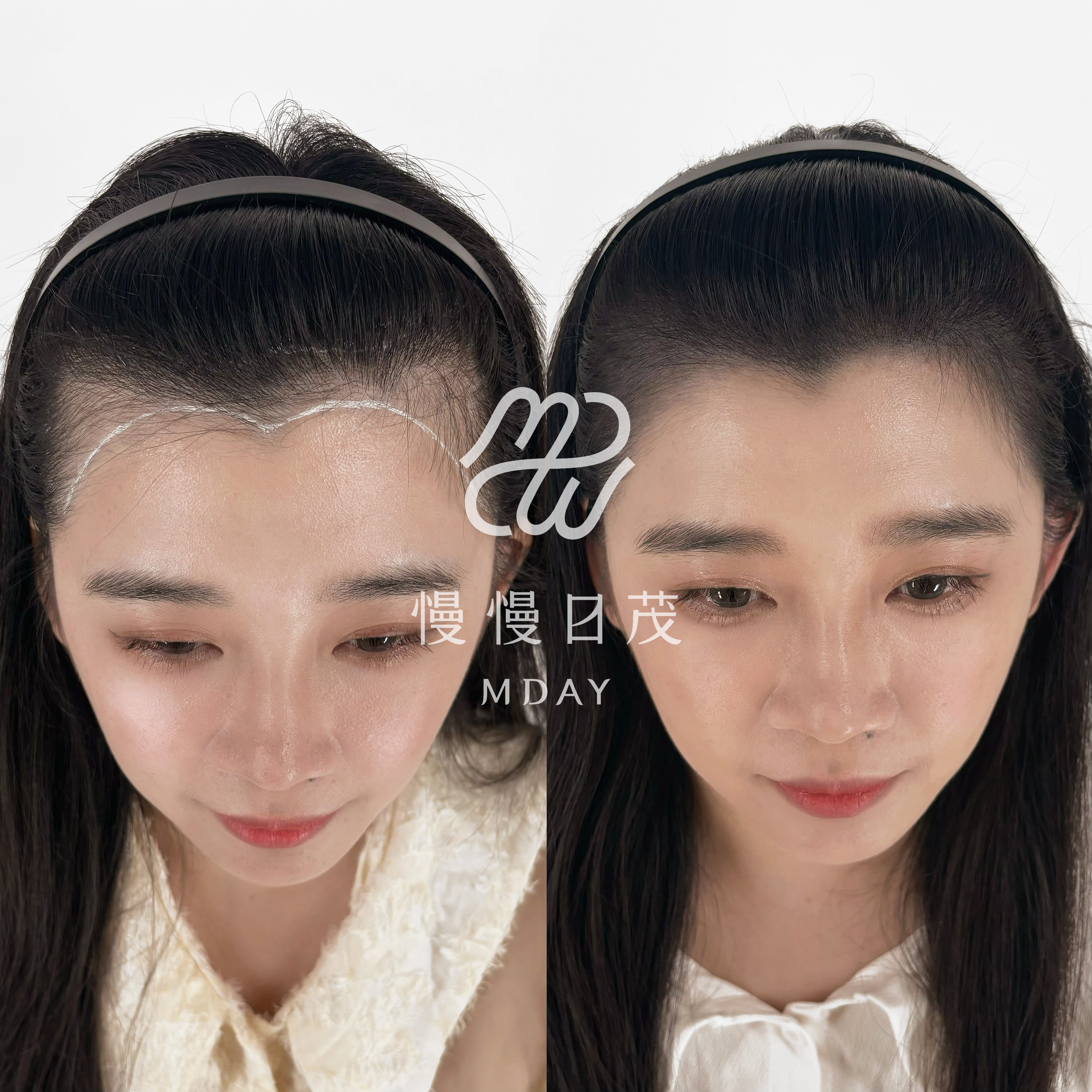 女性髮際線填補