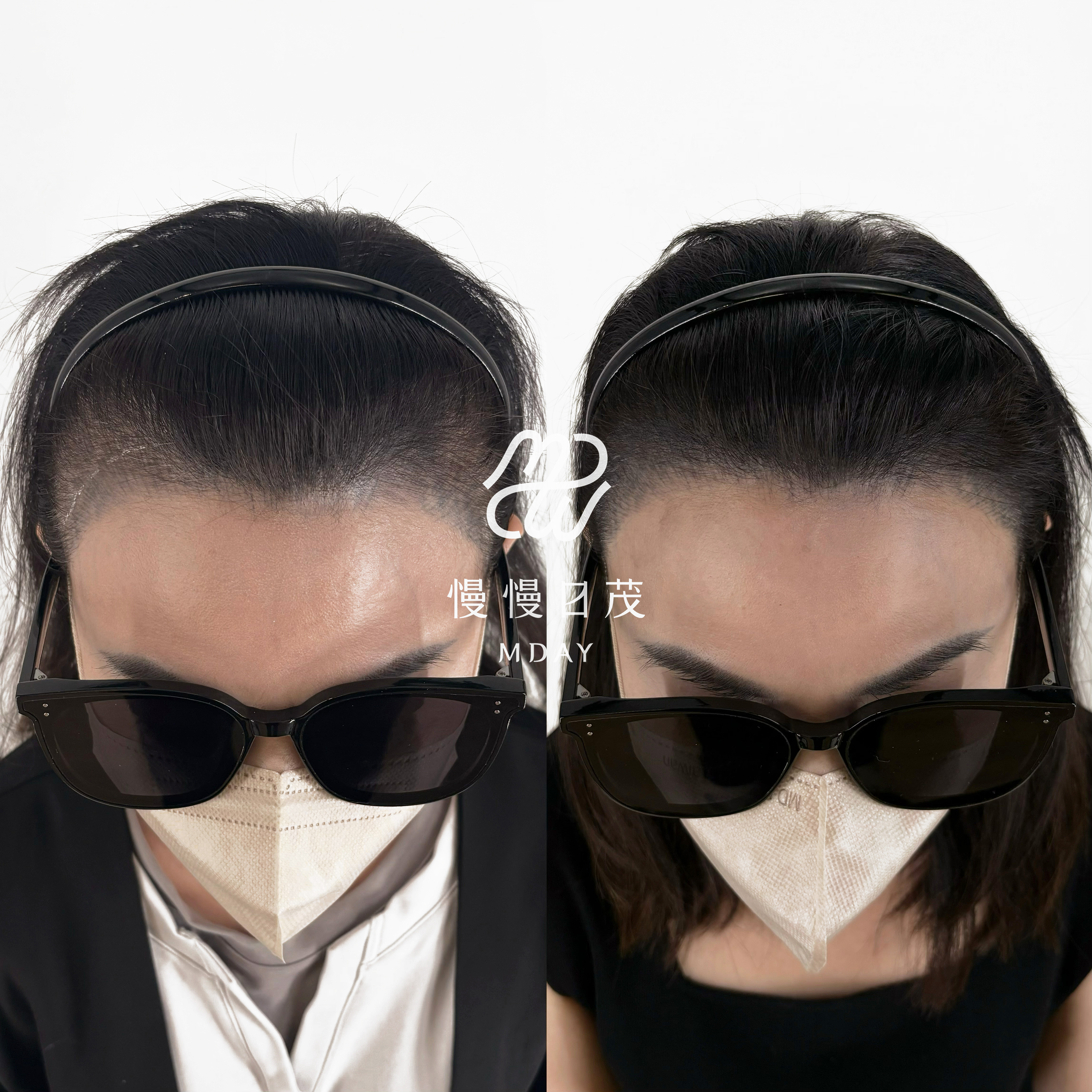 女性髮際線填補