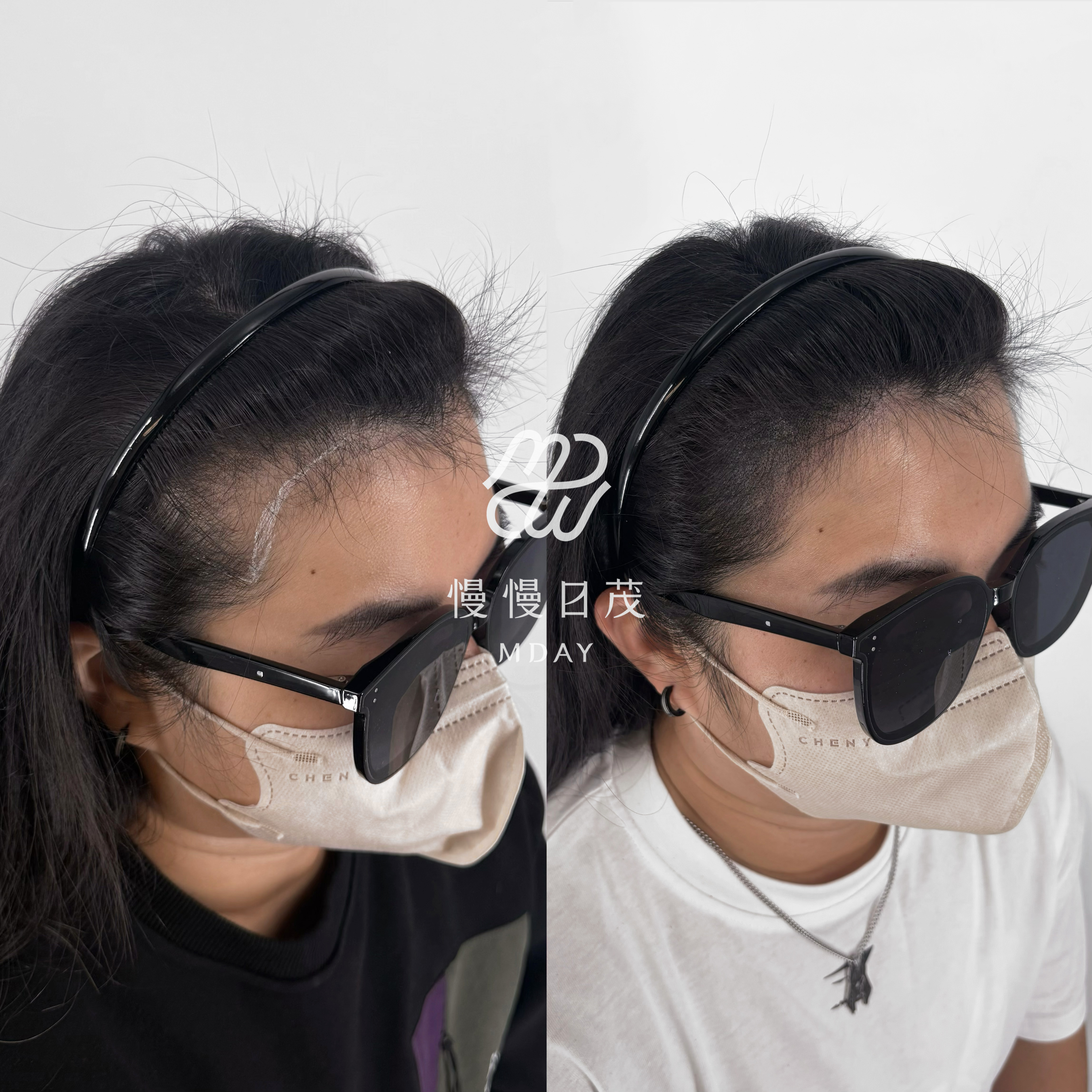 女性髮際線填補