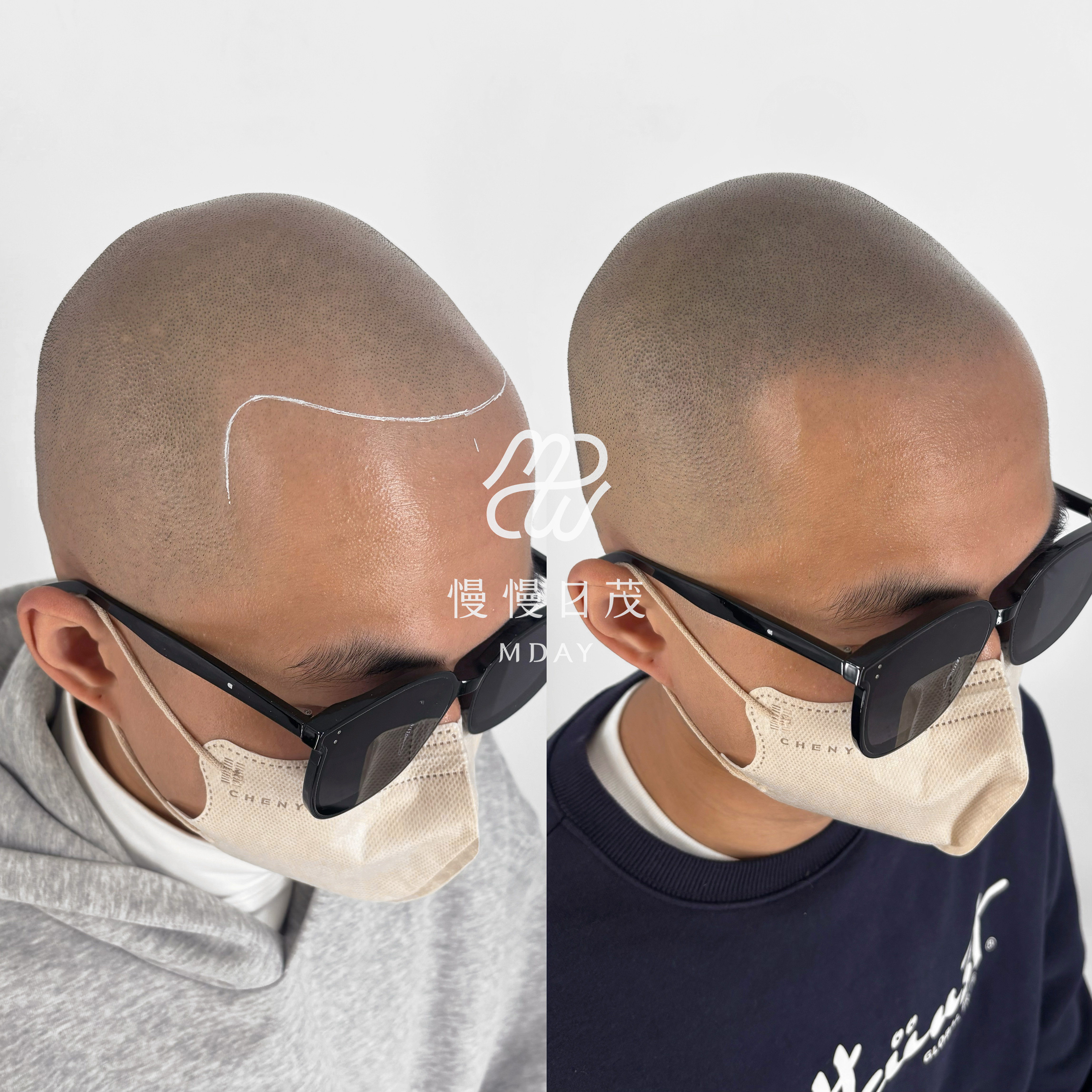 光頭髮際線重建