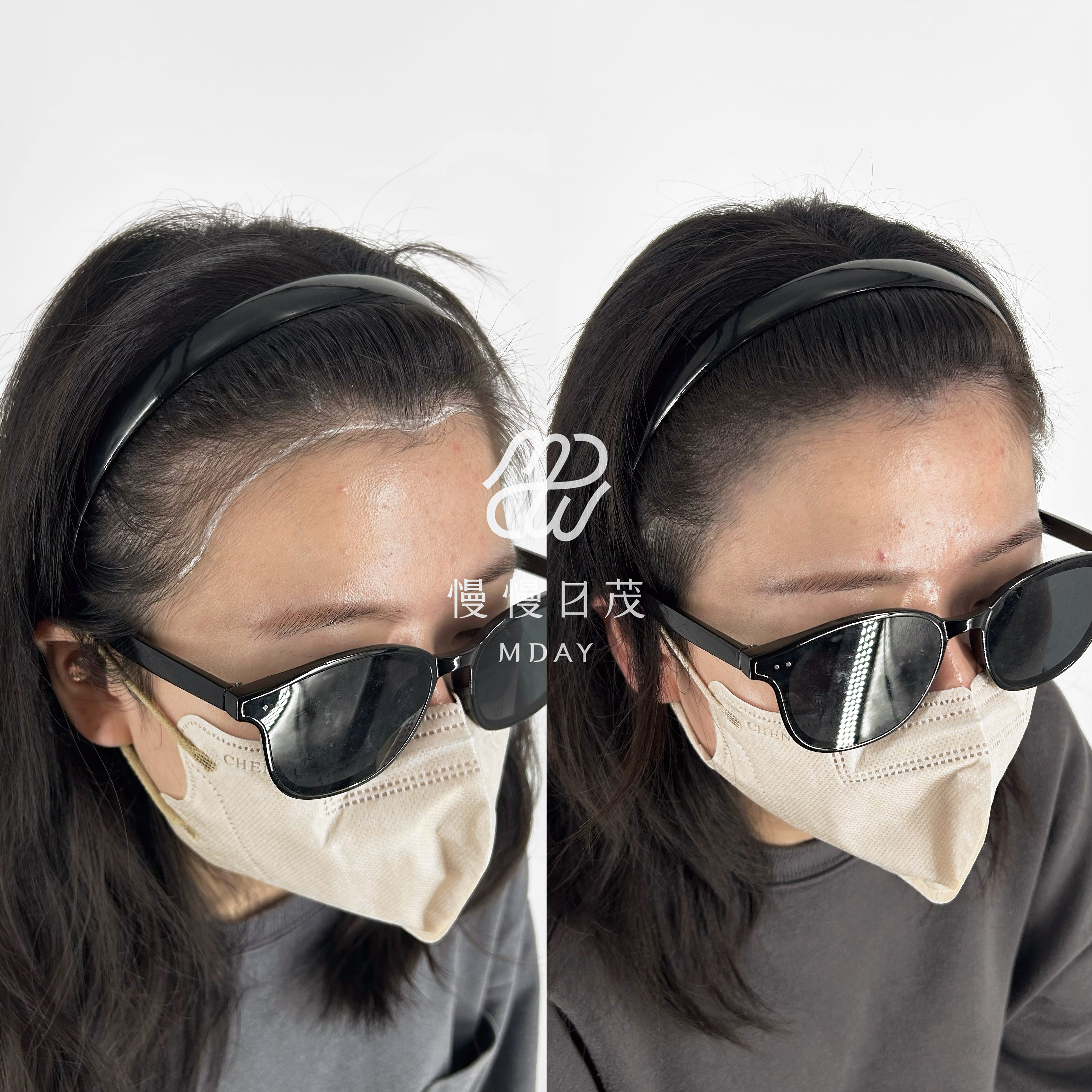 女性髮際線填補