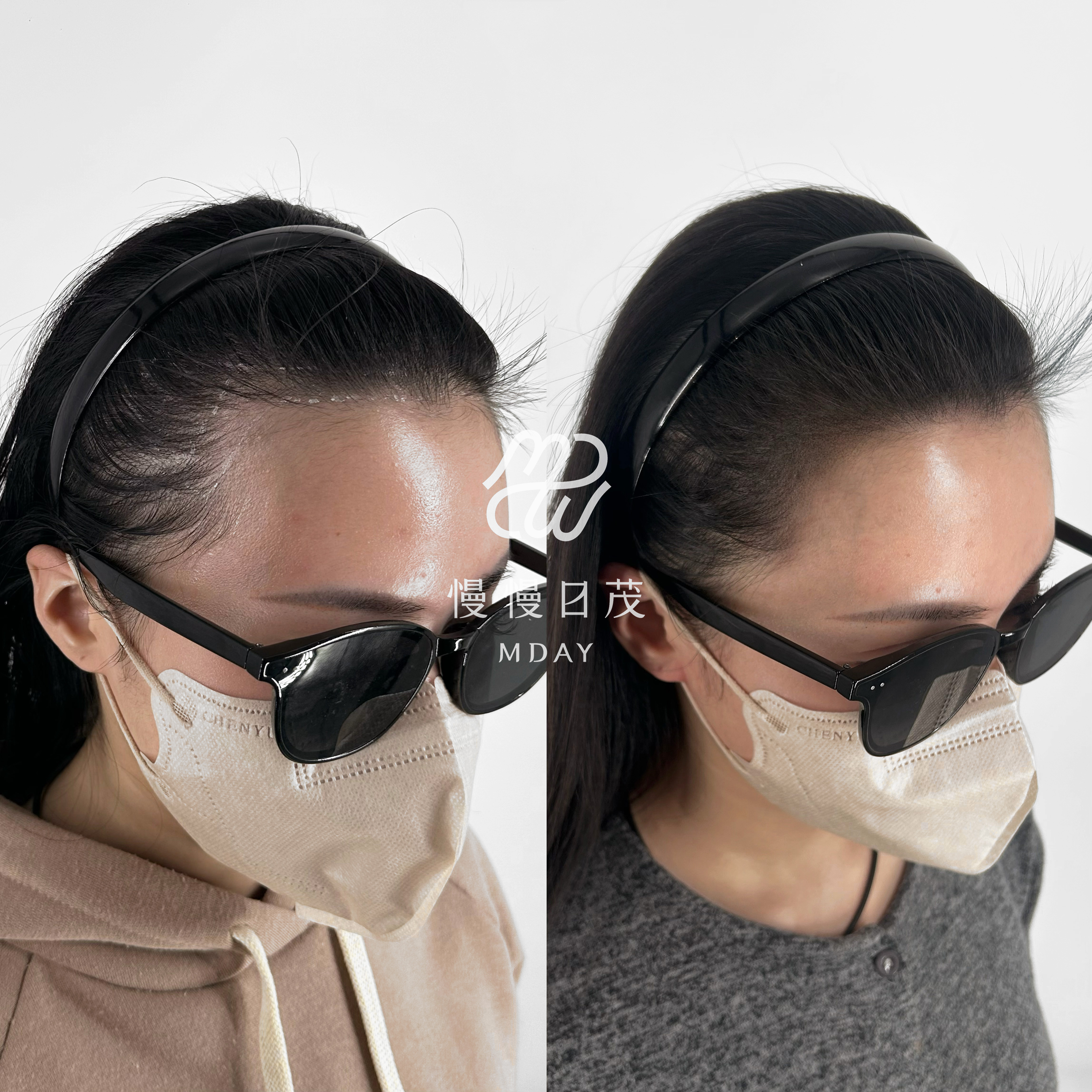 女性髮際線填補