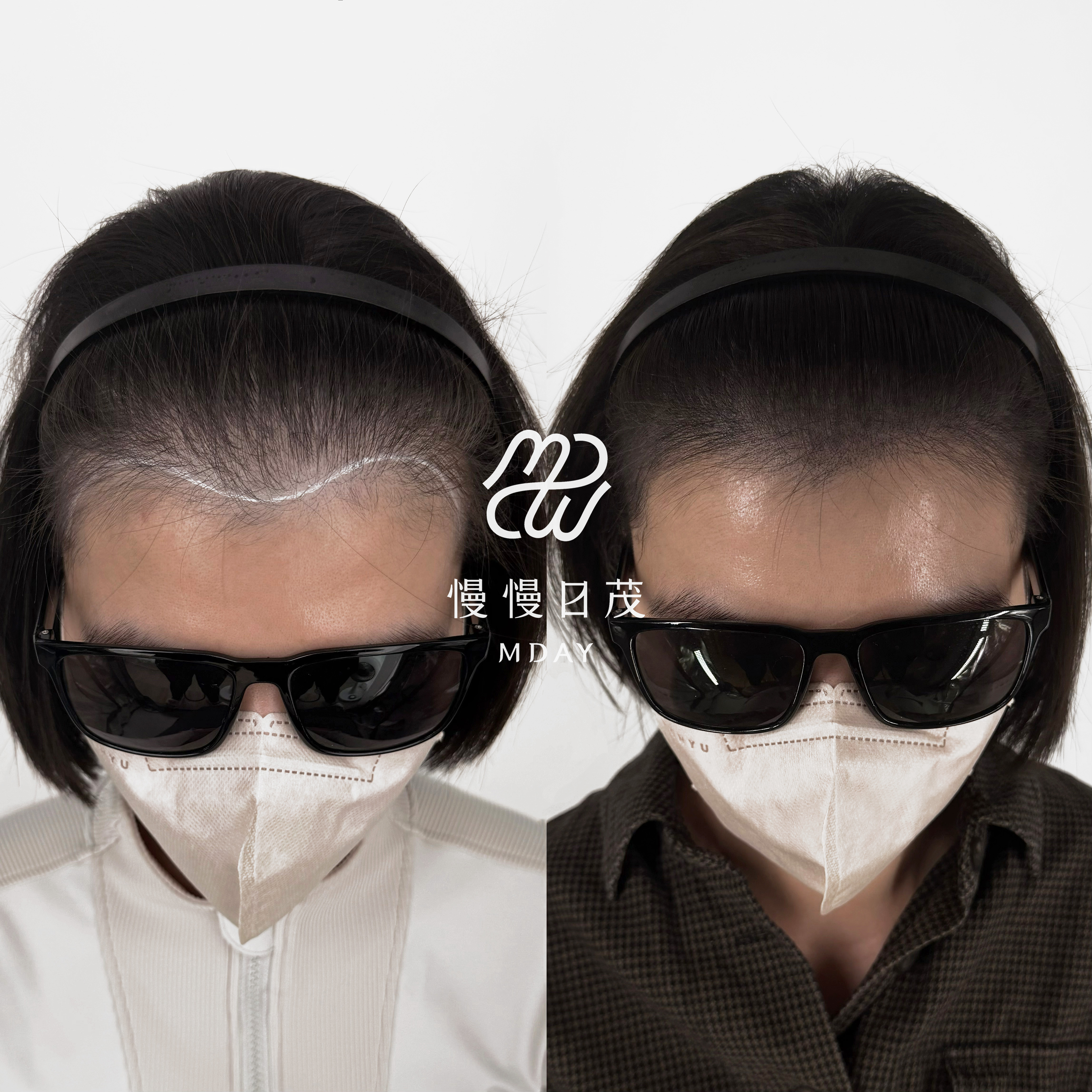 女性髮際線填補