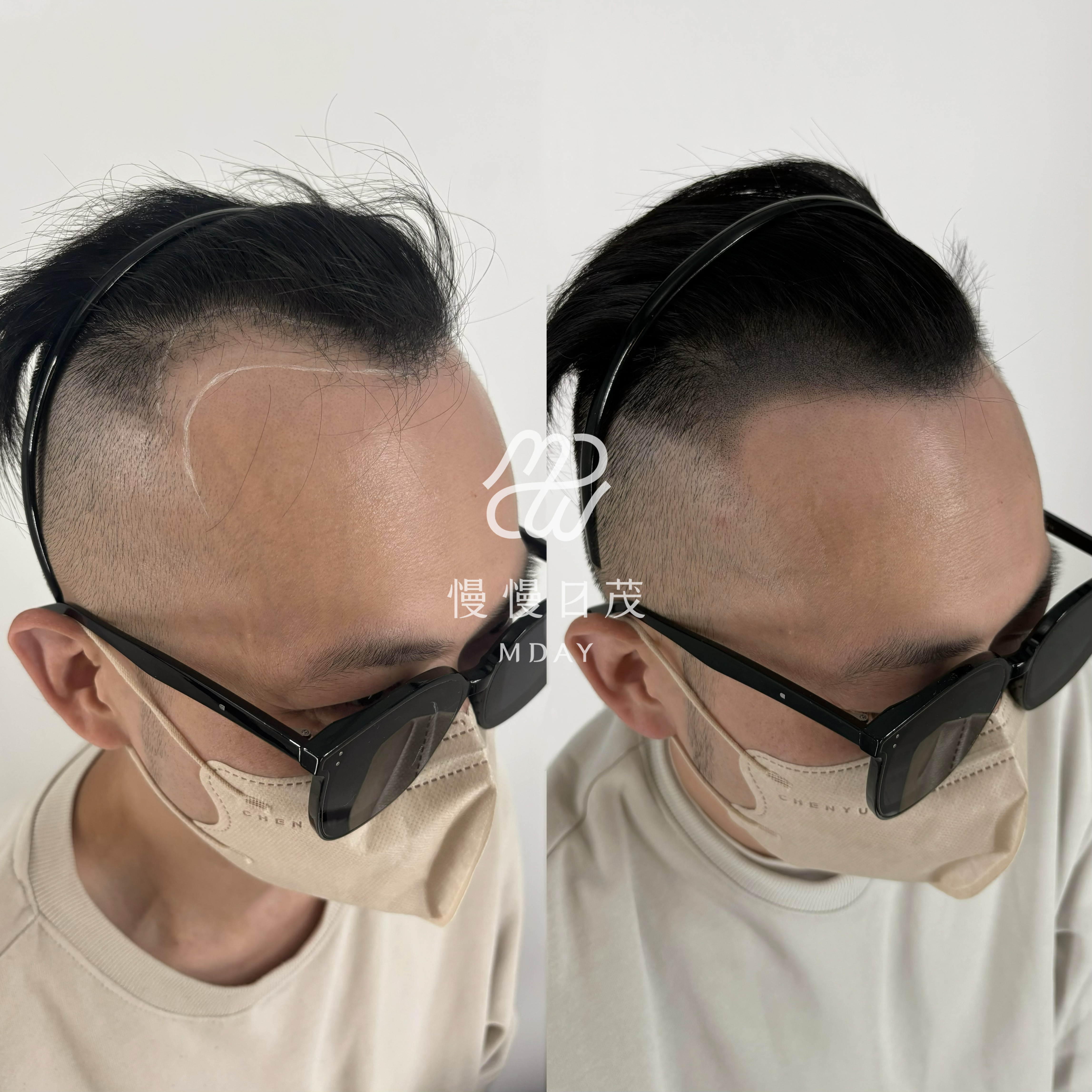 男性髮際線填補