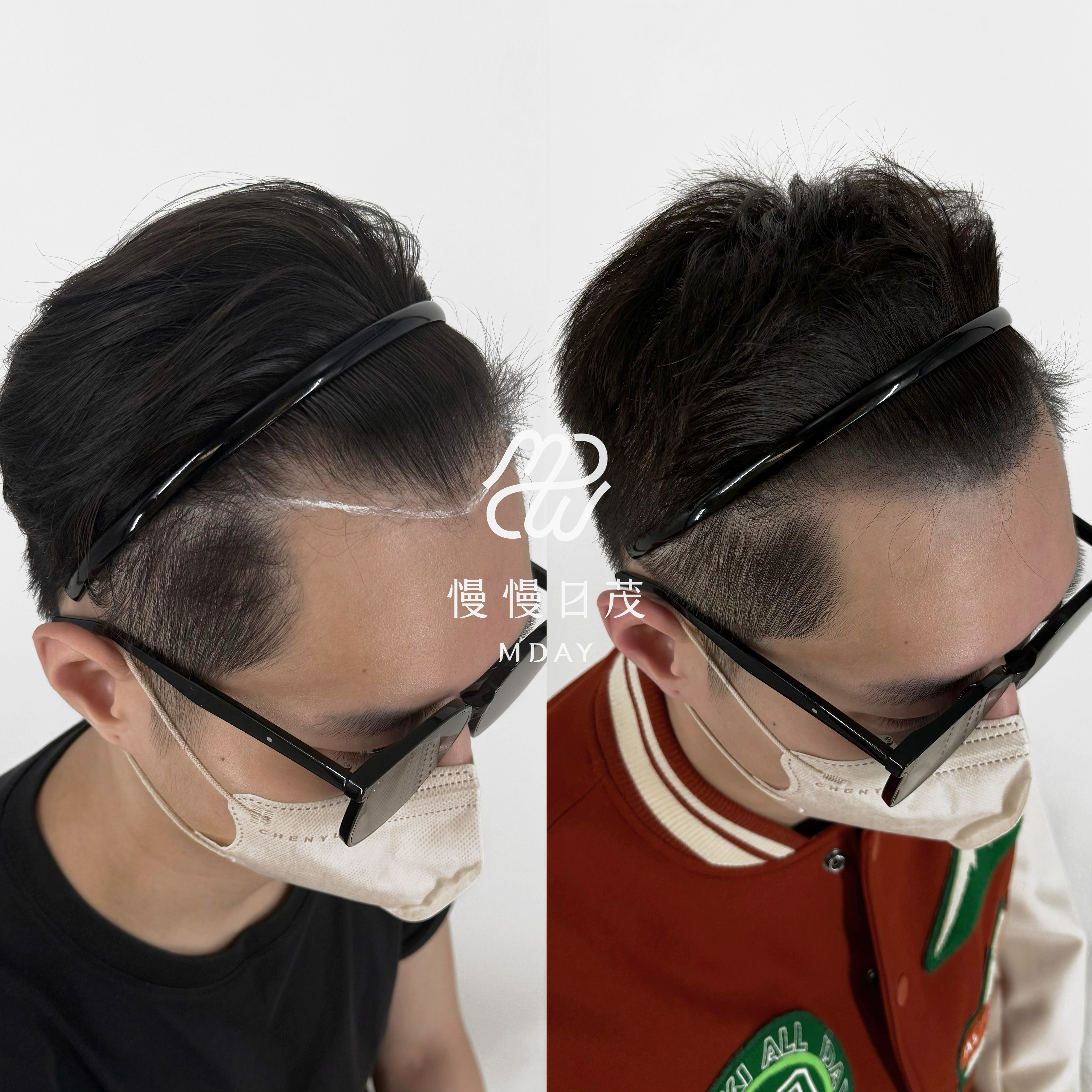 男性髮際線填補