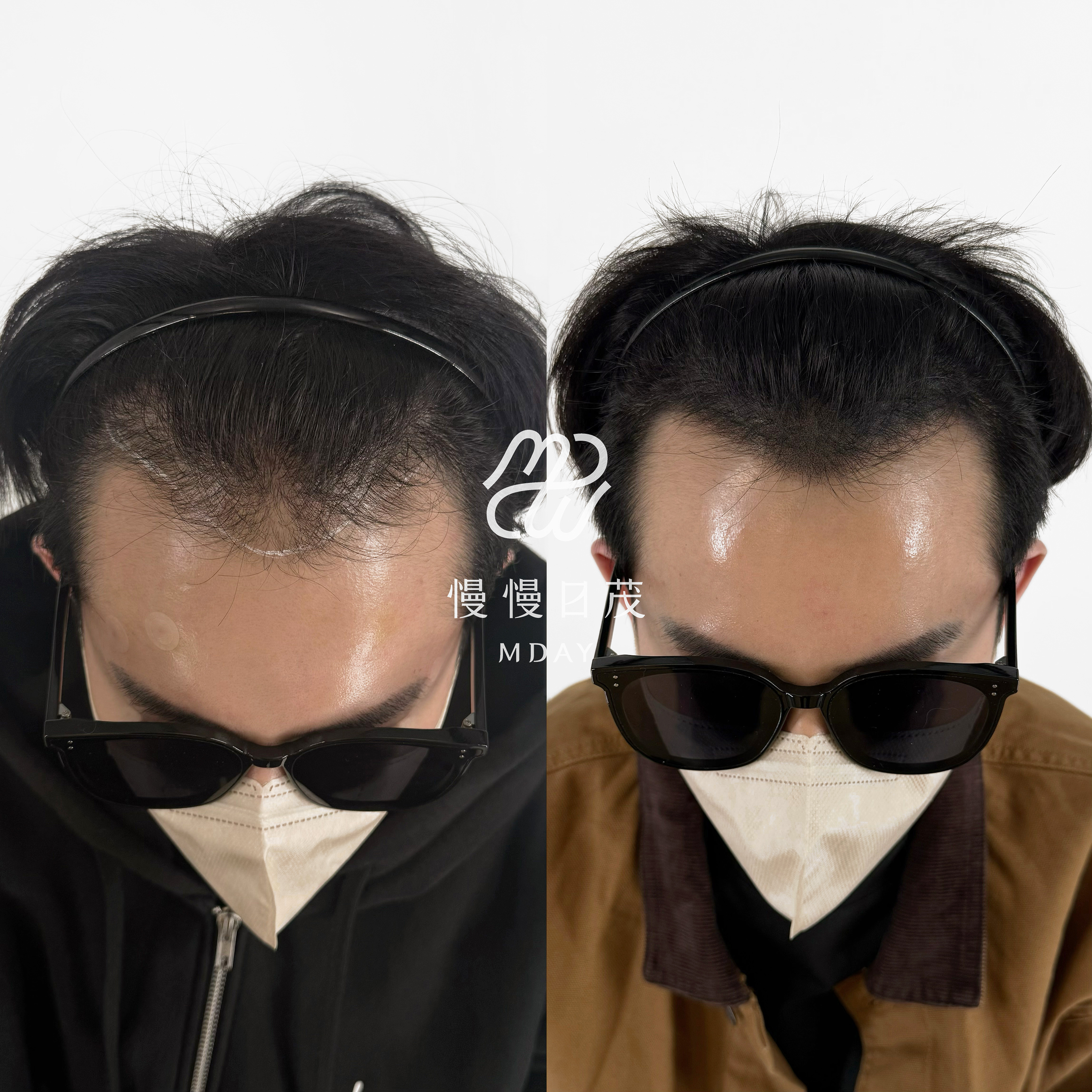 男性髮際線填補