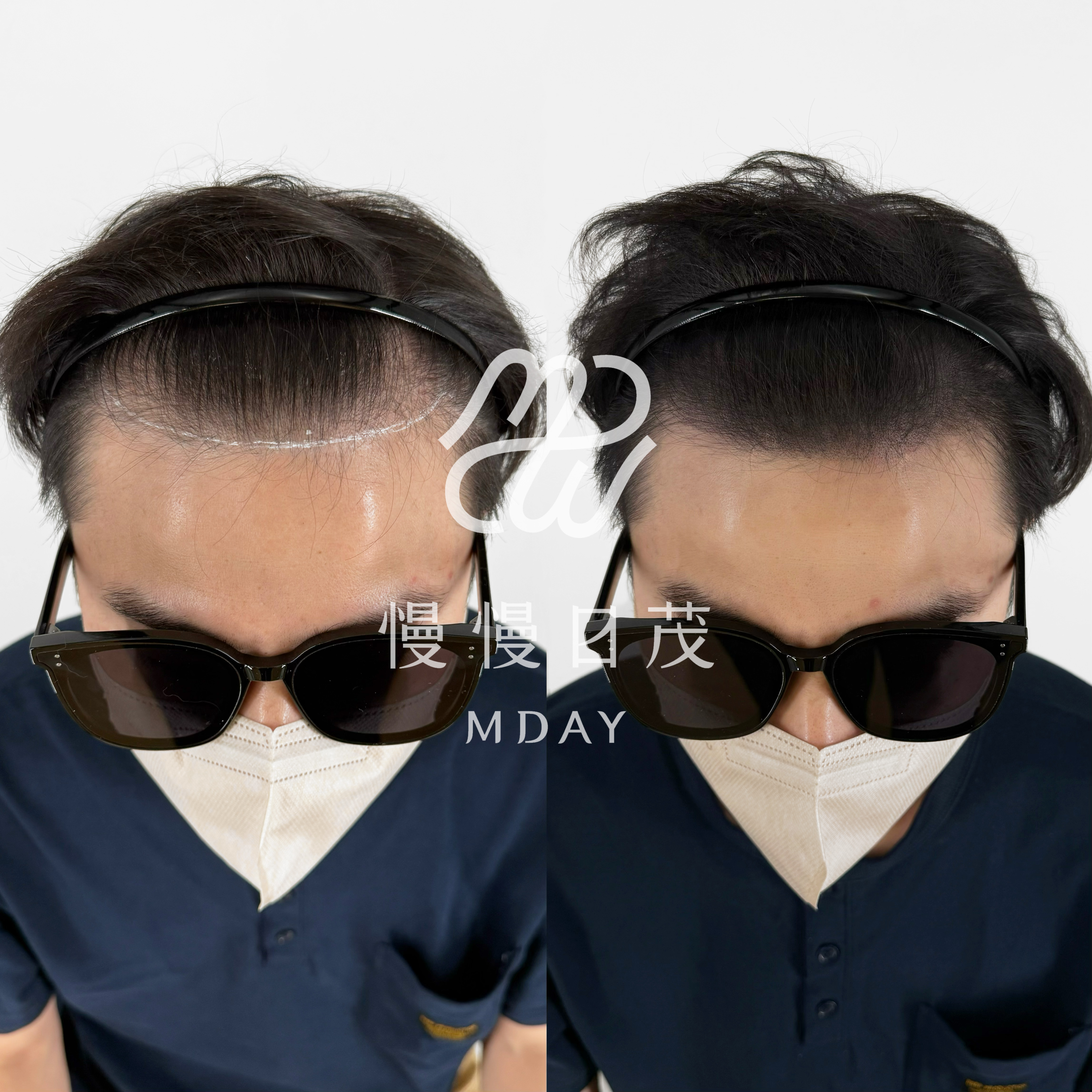 男性髮際線填補