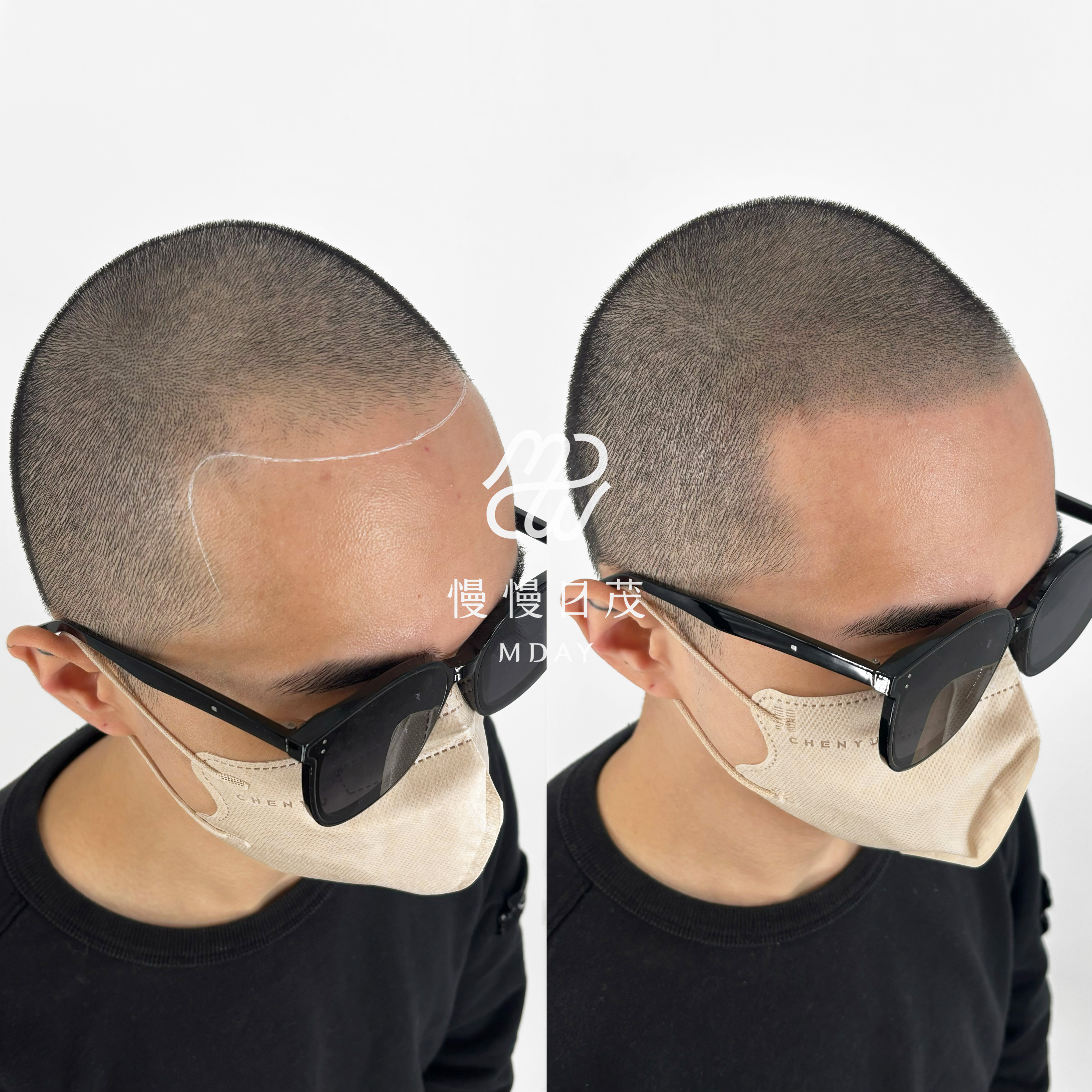 光頭髮際線重建