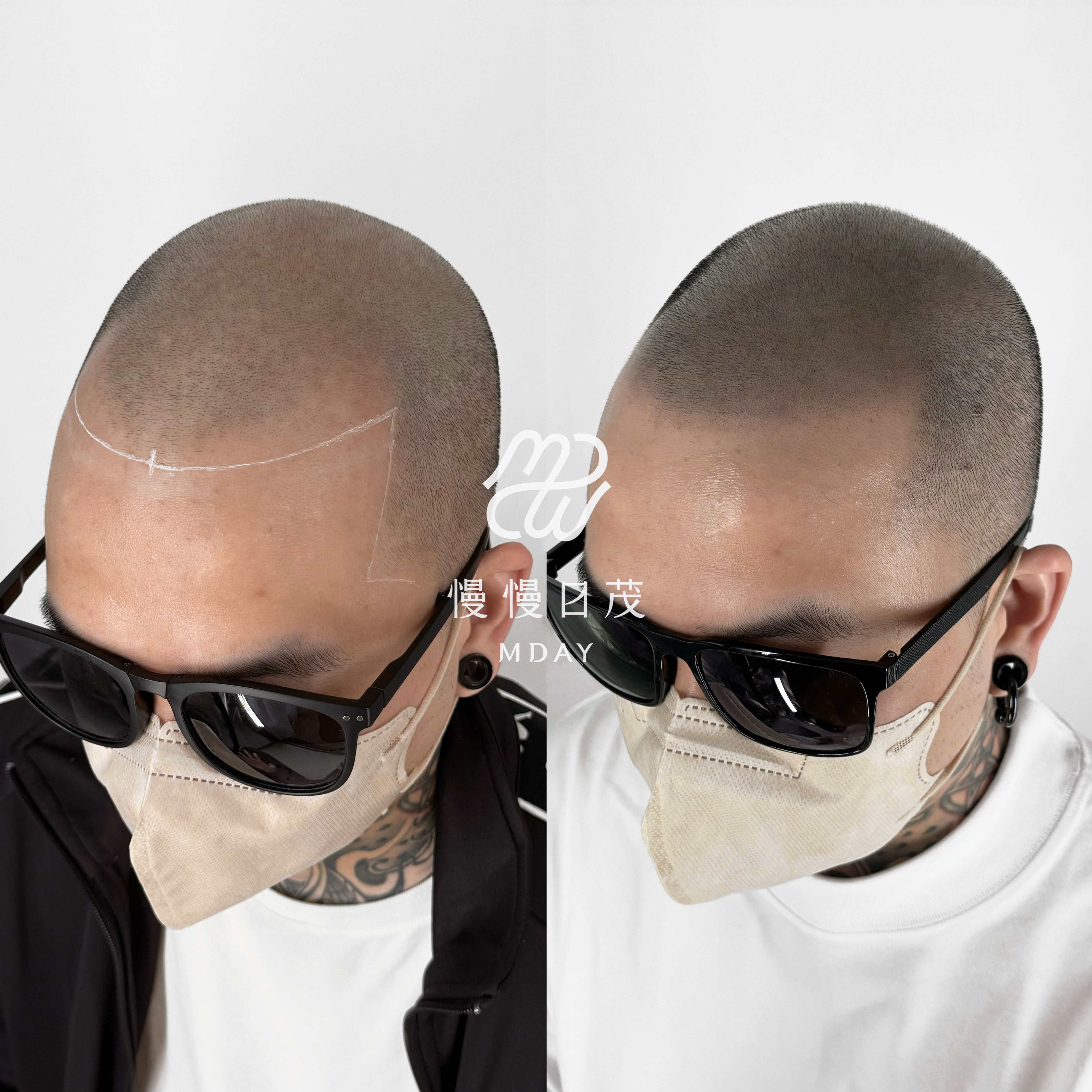 光頭髮際線填補