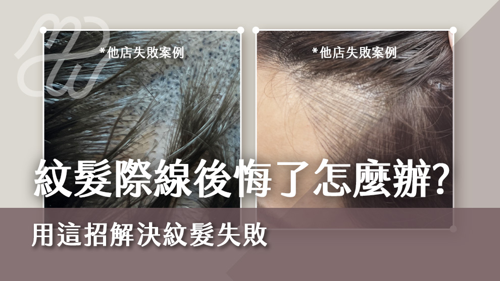 紋髮際線後悔了怎麼辦？用這招解決紋髮失敗