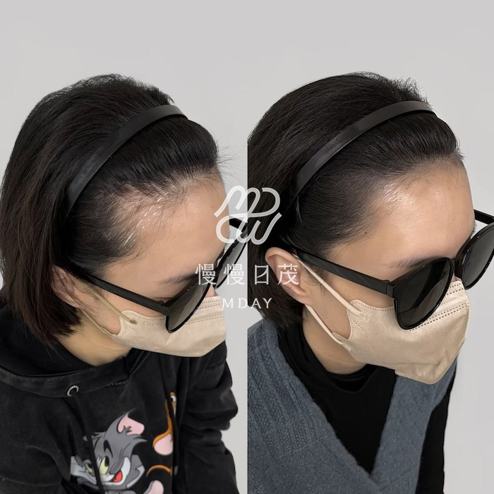 女性髮際線填補