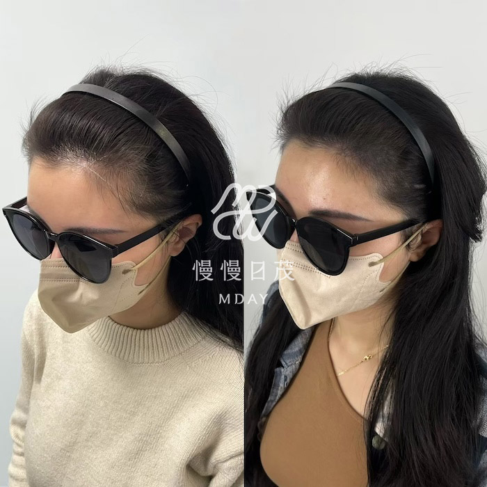 女性髮際線填補