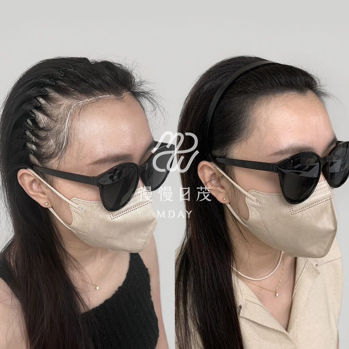 女性髮際線填補