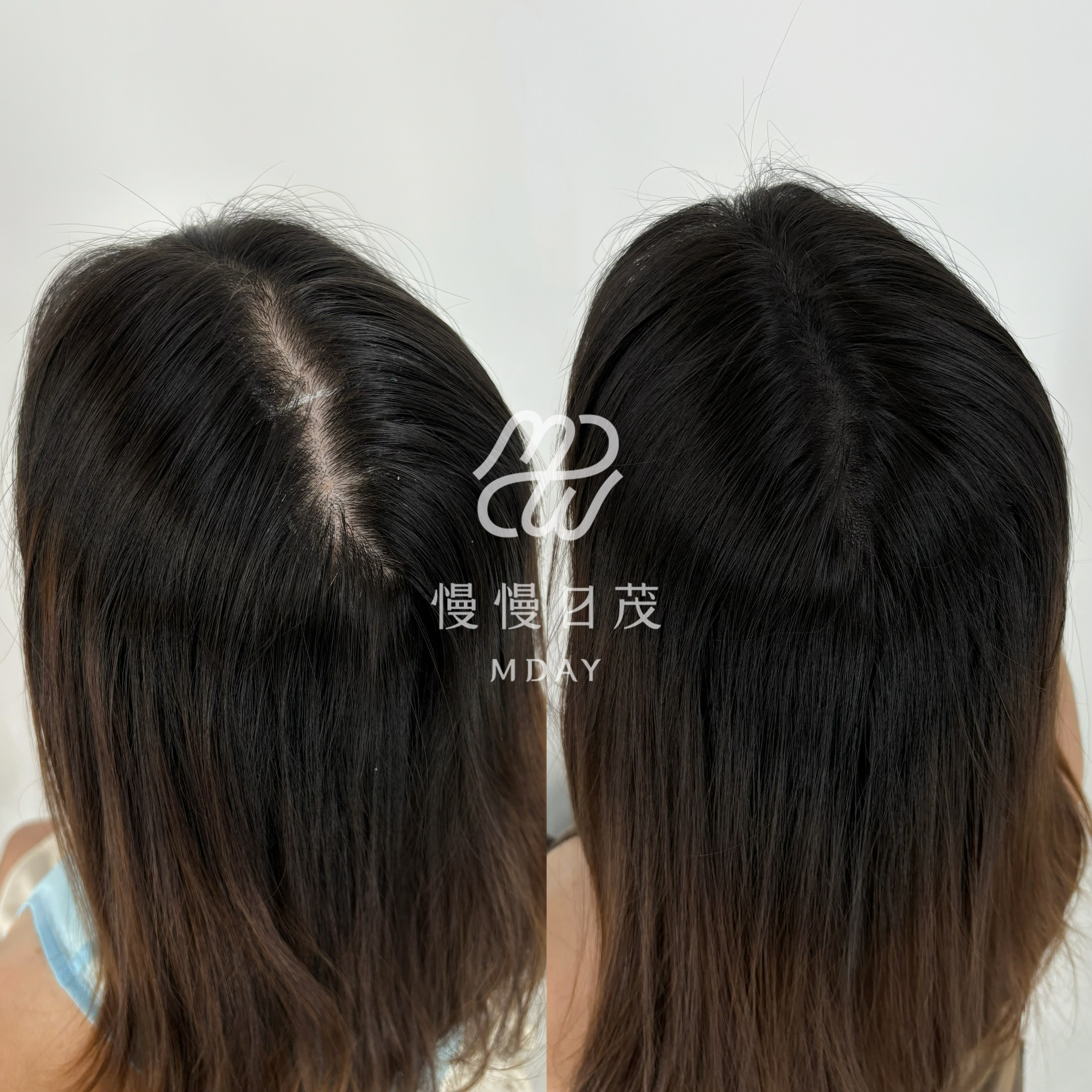 女性後腦勺填補